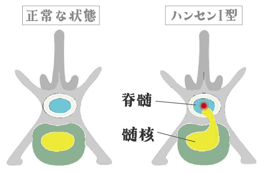 ハンセン1型ヘルニア