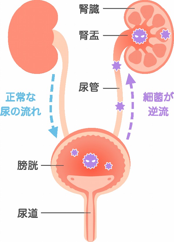 腎盂腎炎